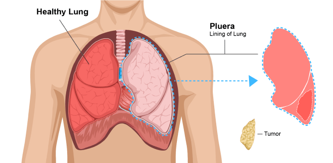 Diagram explaining a pleurectomy with decortication (P/D). Doctors remove the lung lining and cancer tumors. Neither lung is removed in this surgery. 