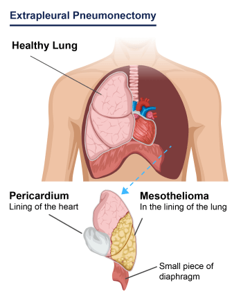 Mesothelioma Prognosis How To Understand Your Prognosis