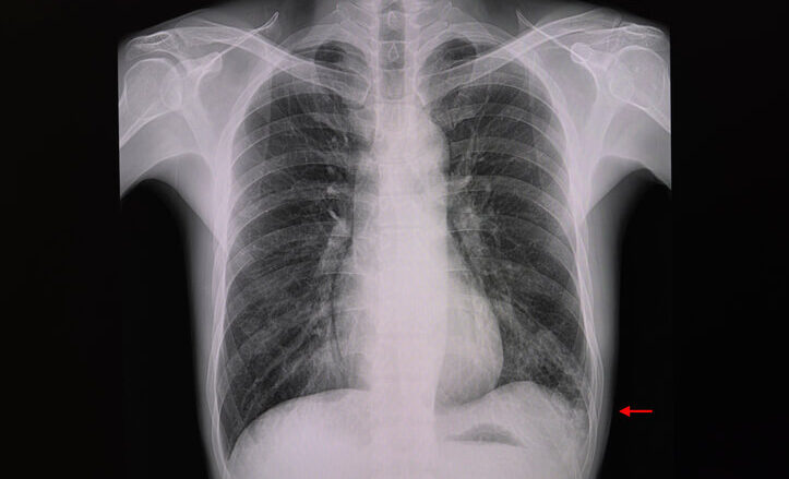 Pleural Diseases Caused by Asbestos Exposure | Veterans at Risk