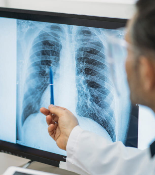 A doctor points to an X-ray of the lungs on a computer screen